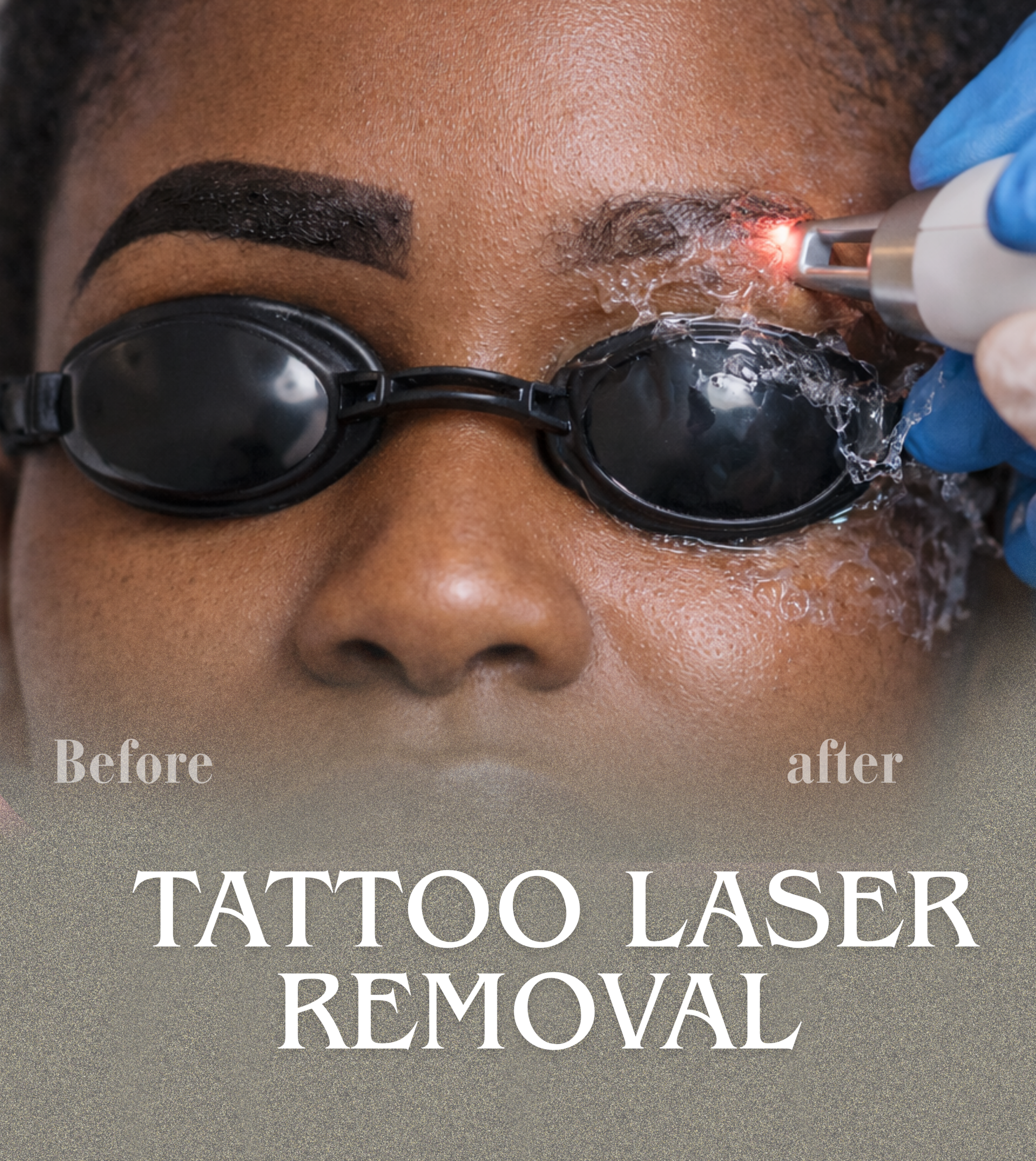 pico laser